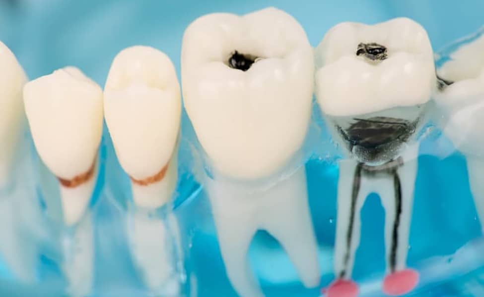 Canva Close up of dental model and caries 1 1