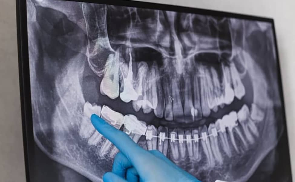 Canva Doctor points wisdom tooth in dental x ray. 1 1