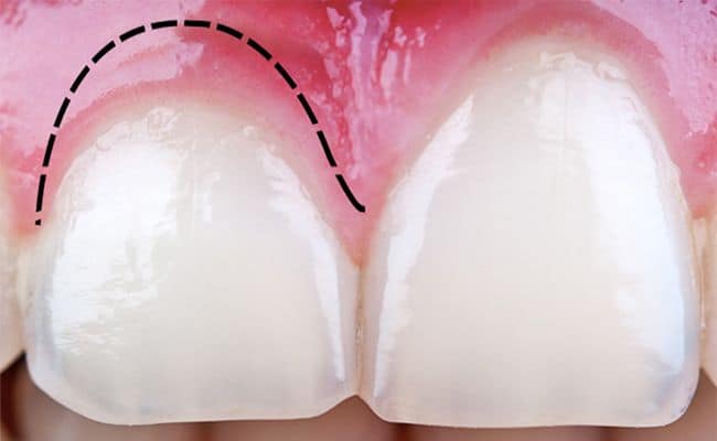 alargamiento de corona 01 periodoncia e implantes monterrey