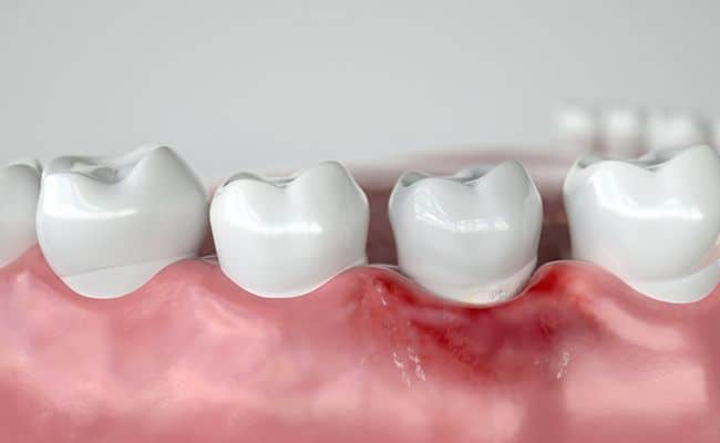 cirugia periodontal 01 periodoncia e implantes monterrey