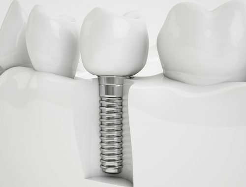corte mostrando implante dental periodoncia e implantes monterrey
