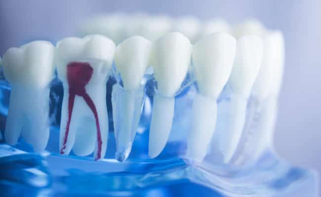 Muestra de dentadura con diente con sangre