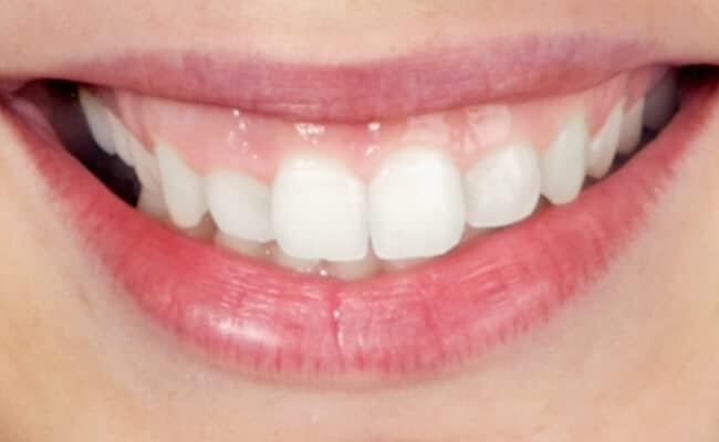 diseno de sonrisa 03 periodoncia e implantes monterrey