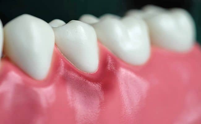 Animación de una enfermedad periodontal