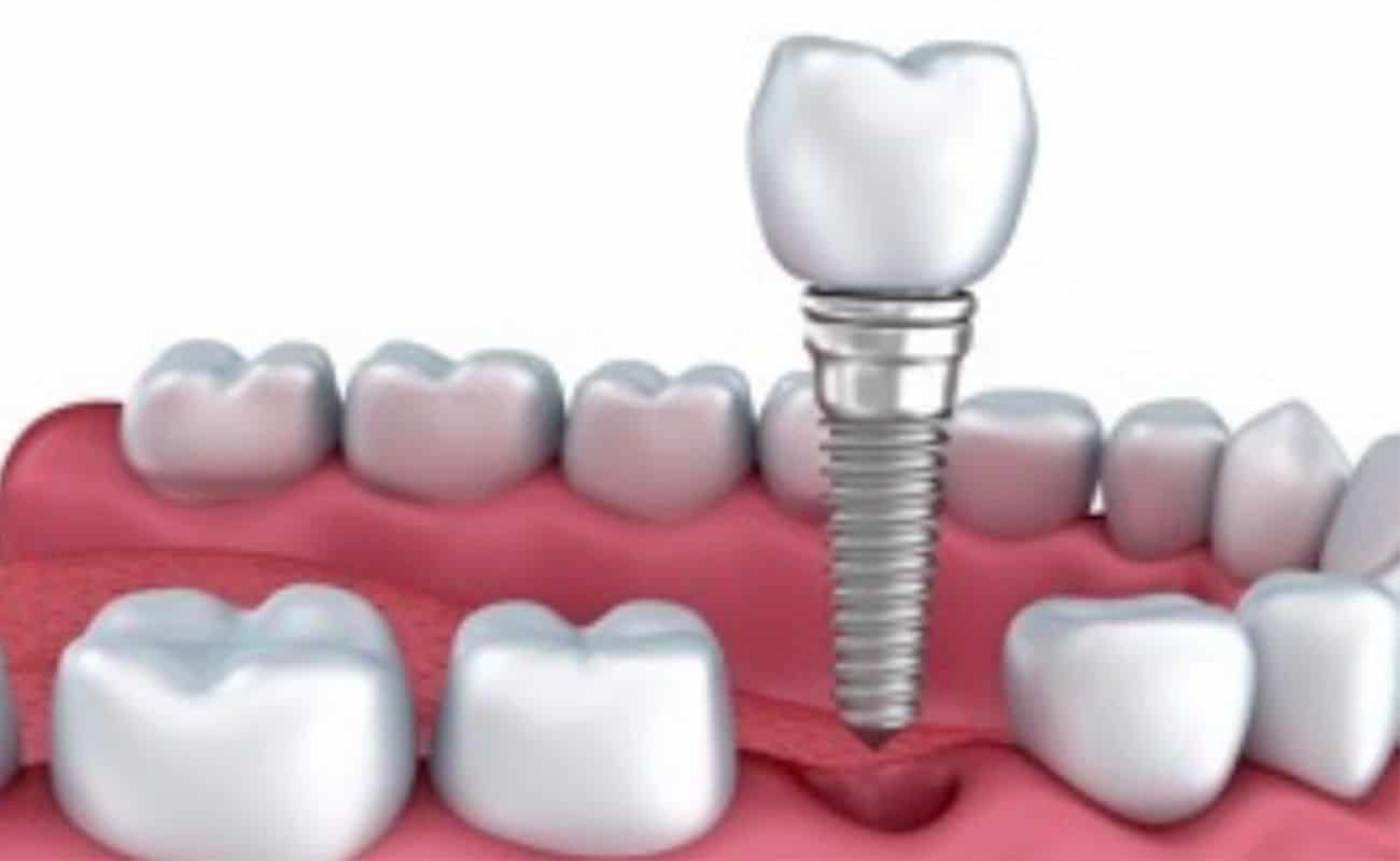 implante dental inmediato periodoncia e implantes monterrey