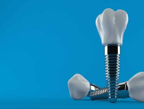 Implantes dentales, coronas de dientes con tornillos sobre fondo color azul