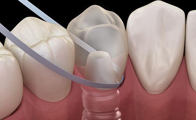 implantes dentales 02 periodoncia e implantes monterrey