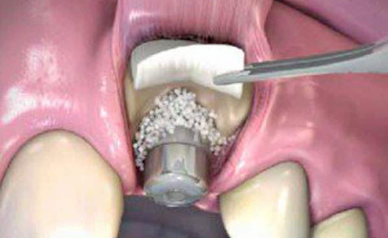 injerto de hueso para implante dental periodoncia e implantes monterrey