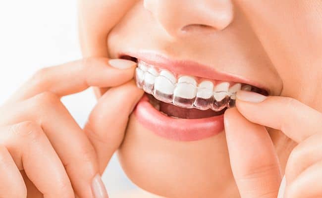 Ortodoncia invisible, paciente coloca tratamiento invisible en sus dientes.
