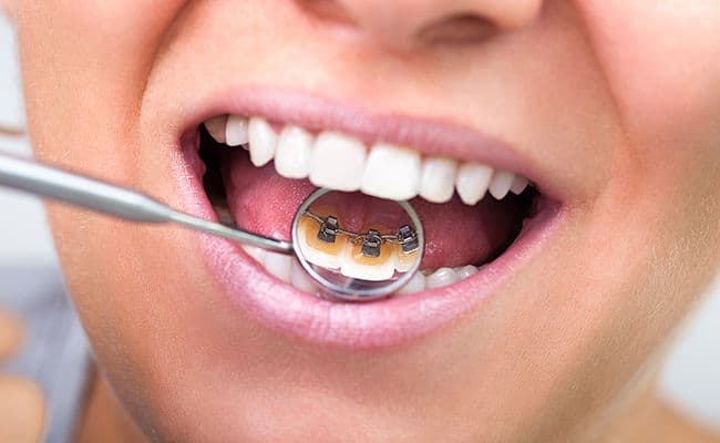 Ortodoncia invisible lingual, periodoncista realiza diagnostico en dientes con braquets.