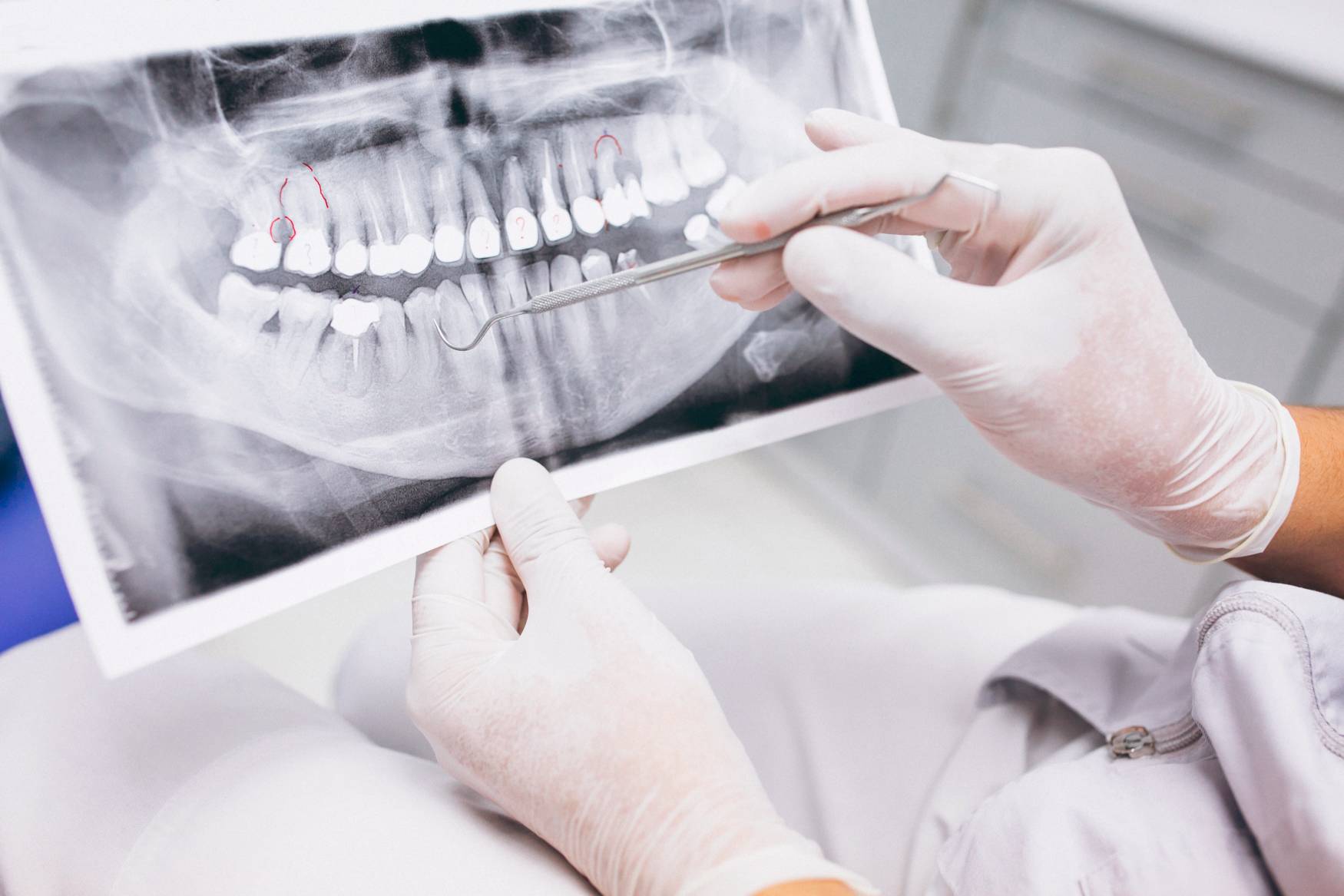 Radiografía de dientes con periodoncia