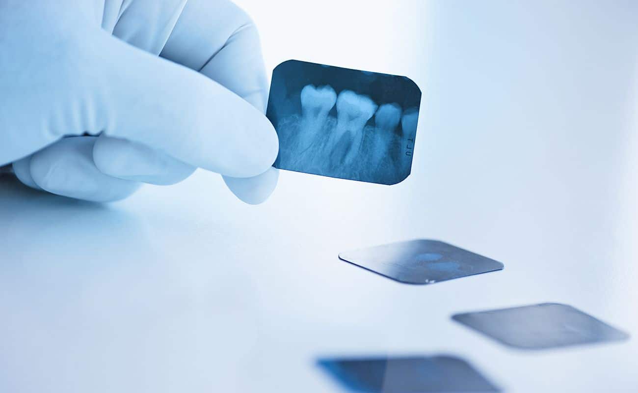 radiografia de colmillo muela y dientes periodoncia e implantes monterrey