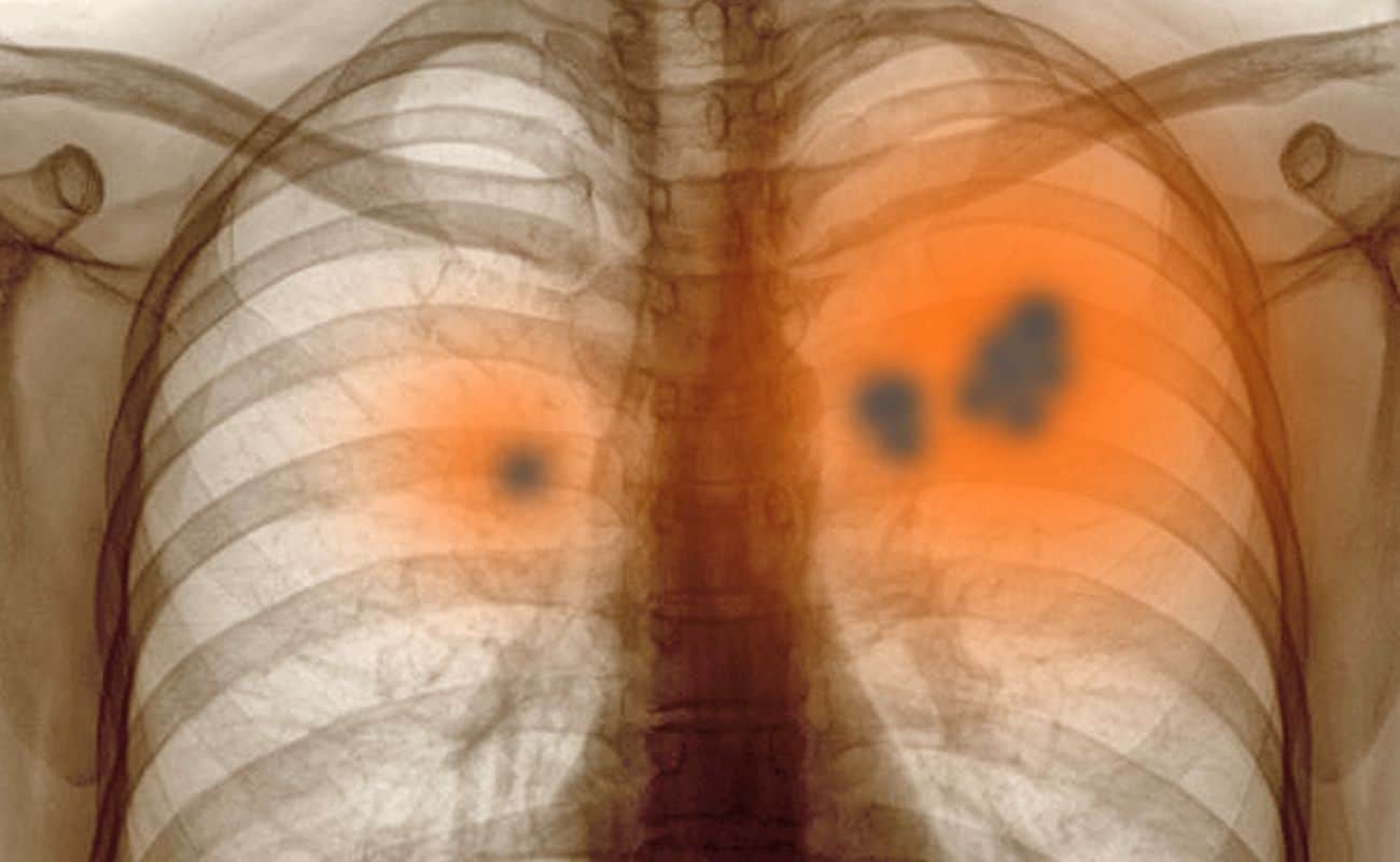 radiografia mostrando cancer pulmonar periodoncia e implantes monterrey