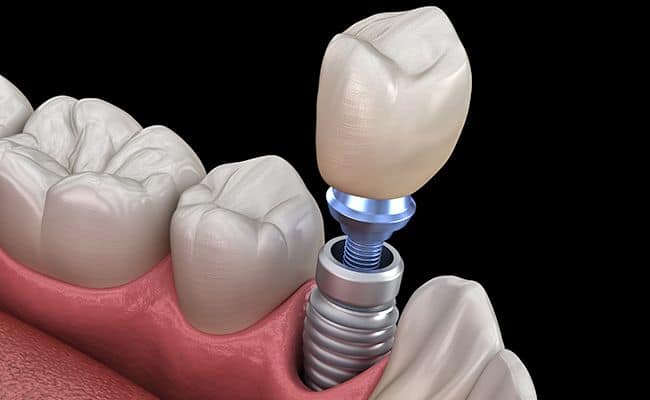 rehabilitacion de implantes dentales 01 periodoncia e implantes monterrey