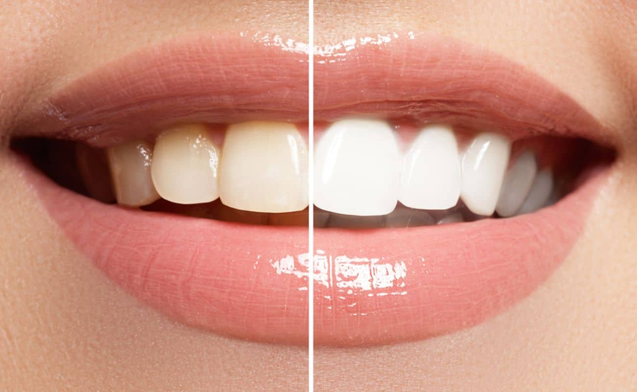 tres aspectos tomar en cuenta cuidado dientes periodoncia e implantes monterrey
